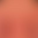Erythrodermie (Übersicht): Erythrodermie bei Sézary-Syndrom
