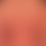 Erythrodermie (Übersicht): Erythrodermie bei Sézary-Syndrom
