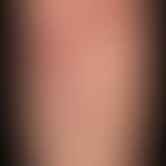 Erythema nodosum: akute, multiple schmerzhafte indurierte Plaques und Knoten.&nbsp;
