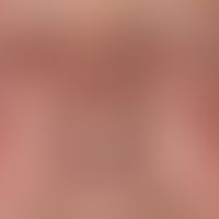 Erysipel akutes: flächenhafte, schmerzhafte Schwlelung und Rötung. Fieber + regionale Lymphadenitis
