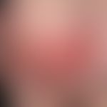 Erysipelas, acute: under high fever, , within 2 days appeared, sharply limited flat, saturated re...