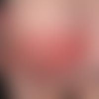 Erysipel, akutes: unter hohem Fieber, , innerhalb von 2 Tagen&nbsp;aufgetretene, scharf begrenzte...
