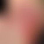 Acute erysipelas. acutely appeared, since a few days existing, increasing, flat, sharply defined,...