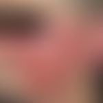 acute erysipelas. acutely appeared, since a few days existing, increasing, flat, sharply defined,...