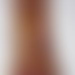 Fasciitis, necrotizing. foot of a 53-year-old patient. after a banal traumatic injury to the inne...