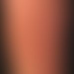 Erythema chronicum migrans. Hier abgebildet ist ein etwa 3 Monate alter Befund. Ca. 10 Tage nach ...