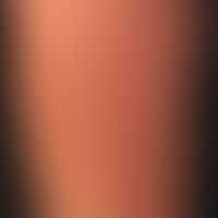 Erythema chronicum migrans. Hier abgebildet ist ein etwa 3 Monate alter Befund. Ca. 10 Tage nach ...