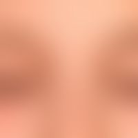 Atopische Liddermatitis: unscharf auf alle Lider begrenzte schuppende und juckende Dermatitis.&nb...