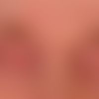 Schwere Atopische Liddermatitis:&nbsp;schwer verlaufende, chronische,&nbsp;persistierende, atopis...