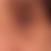 Atopische Liddermatitis: chronische, seit Jahren immer wieder rezidivierende, &nbsp;beidseitige D...