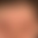 Dermatitis&nbsp;seborrhoische: chronisch rezidivierendes Krankheitbild mit ortskonstanten, unscha...