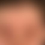 Dermatitis, seborrhoeic: chronically recurrent disease with constant, blurred, sometimes slightly...