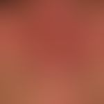 Dermatitis, seborrhoeic: Flat, symmetrical (butterfly-like - DD: rosacea, systemic lupus ertyhema...