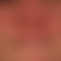 Dermatitis, seborrhoeic: Flat, symmetrical (butterfly-like - DD: rosacea, systemic lupus ertyhema...