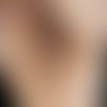 Fibroma molle bei Acanthosis nigricans
