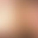 Fibroma molle. Zahlreiche, gestielte, pendulierende, weiche, hautfarbene oder leicht bräunliche, ...