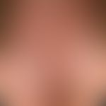 Alopecia androgenetica beim Mann. Stadium IV: Konfluenz der vorderen und hinteren Haarlichtung in...