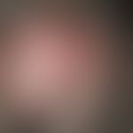 Folliculitis decalvans. 3 years of persistent scarring hair loss, with initially slight itching. ...