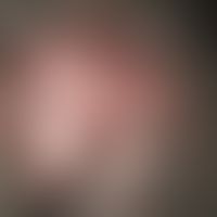 Folliculitis decalvans. 3 years of persistent scarring hair loss, with initially slight itching. ...
