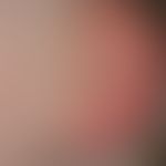 Ear fistula and cyst, congenital findings,congenital, no symptoms so far. The external fistula op...