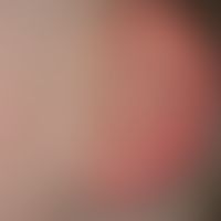 Ear fistula and cyst, congenital findings,congenital, no symptoms so far. The external fistula op...