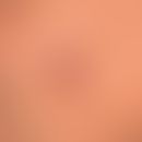 Deep folliculitis (boils)
