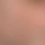 Folliculitis barbae: Chronic, therapy-resistant, inflammatory, itchy (lesions show signs of scrat...