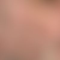 Folliculitis barbae: Chronic, therapy-resistant, inflammatory, itchy (lesions show signs of scrat...