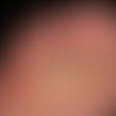 Fußinfekt, gramnegativer. Flächige,schmerzhafte Mazerationen an Zehen und Fußballen. Scharf begre...