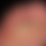 Fußinfekt, gramnegativer. Flächige,schmerzhafte Mazerationen an Zehen und Fußballen. Scharf begre...