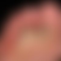 Fußinfekt, gramnegativer. Flächige,schmerzhafte Mazerationen an Zehen und Fußballen. Scharf begre...