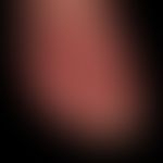 Fußinfekt gramnegtiver: Dorsalseite bei gramnegatviem Fußinfekt.
