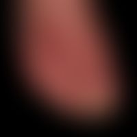 Fußinfekt gramnegtiver: Dorsalseite bei gramnegatviem Fußinfekt.
