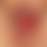 Fournier Gangrän: Seltene Form einer akuten Gangrän der Vulva.&nbsp;63-Jahre alte Patientin. Rasc...