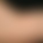 Gianotti-Crosti-Syndrom (s. zuvor): Disseminierte Papulo-Vesikeln am Handrücken und Unterarm.
