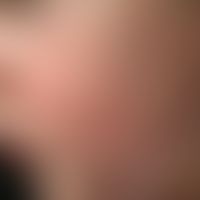 Gianotti-Crosti syndrome: Acutely occurring exanthema with disseminated, in the centre of the che...