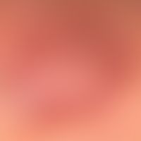 Granuloma faciale: Detailed view. large lump with smooth surface. strikingly large and bizarre tu...