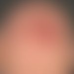 facial granuloma: red lump, existing for 5 years now, slowly progressing in size and limited in s...