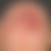 Granuloma faciale: Seit&nbsp;nunmehr 5 Jahren bestehender, langsam größenprogredienter, zackig be...