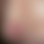 Granuloma faciale:  The otherwise healthy 37-year-old patient has been noticing this painless, re...