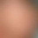 Gneiss: greasy, scaling on the capillitium of the infant (does not itch, does not hurt, only dist...