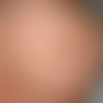 Eczema seborrhoeic of the infant: On the capillitium, also called gneiss, evenly distributed, gre...