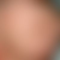 Eczema seborrhoeic of the infant: On the capillitium, also called gneiss, evenly distributed, gre...