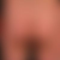 Psoriasis: Extensive, untreated plaque psoriasis, in addition to larger, in places confluent plaq...