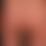 Chronisch-stationäre Psoriasis (PLaque-Typ): unvorbehandelte, großflächige Psoriasis mit dichtem ...