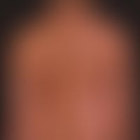 Psoriasis vulgaris as a cutaneous mosaic (distribution pattern in the Blaschko lines) The changes...