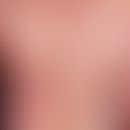 Psoriasis vulgaris chronic inpatient (plaque type): Untreated, chronic staionary psoriasis with w...