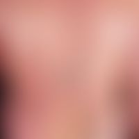 Psoriasis vulgaris chronisch-stationäre (Plaque-Typ): Unvorbehandelte, chronisch staionäre&nbsp;P...