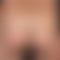 Psoriasis vulgaris vom Plaque-Typ: Unbehandelte Ausgangssituation. 4 Monate nach durchgeführter T...
