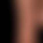 ILVEN: Linearly arranged, eczematous (histology: superficial perivascular and interstitial spongi...